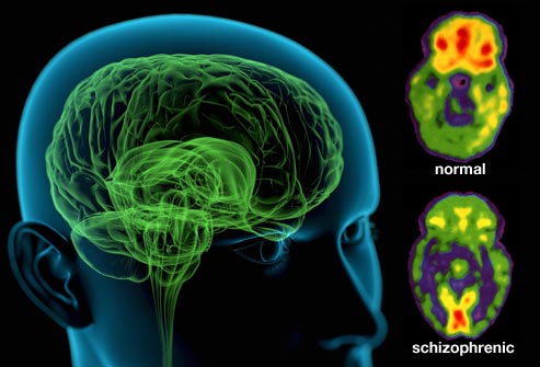 A Beautiful Mind-2. PHYSICAL IMPAIRMENTS