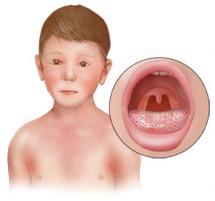 Scarlet Fever - Its Symptoms