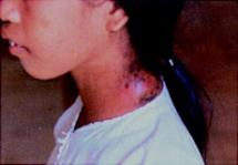 Infected Plague Nodes on a Human Neck