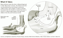 Tommy John Surgery