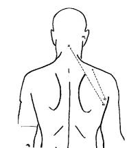 Diagram of Kennedy's Wound